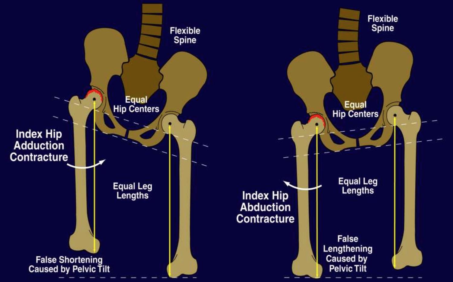 Blog Are Your Legs The Same Length